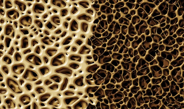 This illustration shows healthy, strong bone tissue, at left, compared to bone tissue that has weakened and lost density.