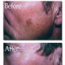 Age Spot Removal