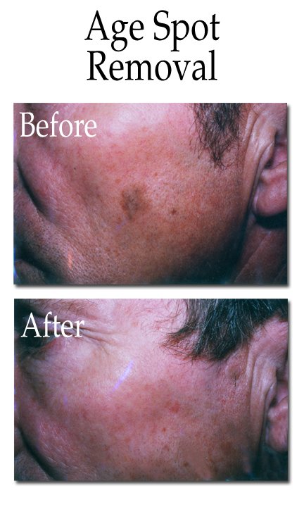 Age Spot Removal | Dermatology Center of Lawrence - Dr 