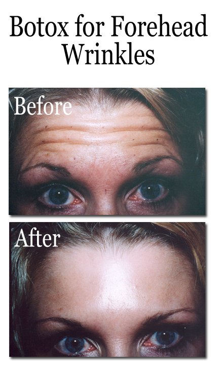 Botox for Forehead Wrinkles