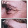 Botox for Crow's Feet