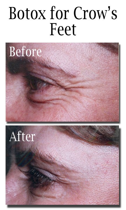 Botox for Crow's Feet