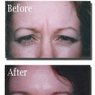 Botox for Frown Lines