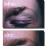 Mole Removal In Hair