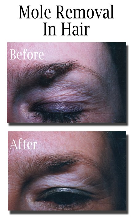Mole Removal In Hair