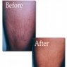 Sclerotherapy for Spider Veins