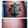 Tattoo Removal by Dermabrasion