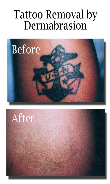 Tattoo Removal by Dermabrasion | Dermatology Center of ...