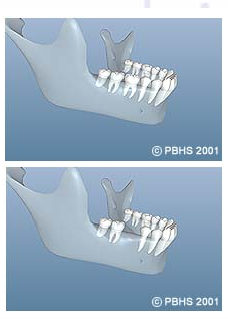 Dental Implants