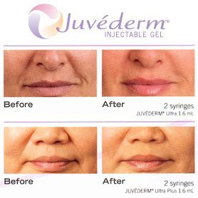 Juvéderm