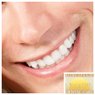 Porcelain Veneers