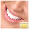 Porcelain Fillings