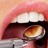 Cerec One Visit Crowns