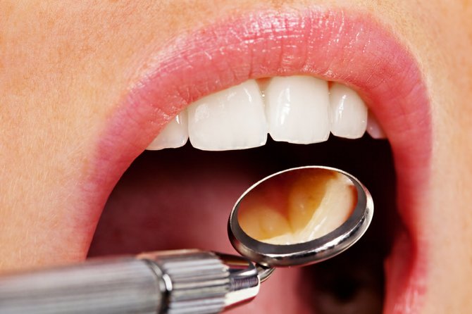 Cerec One Visit Crowns