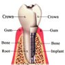 Implant Dentistry