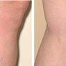 Vein Treatment - Sclerotherapy