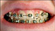 Mike Westheffer, a seventh-grader at Central junior high, flashes
his braces. Teens say braces are worth the cost and help
self-esteem.