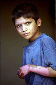 Haidar Falah Mutlaq, 10, keeps his left fingers bent and hops on
his left leg because it's too painful to use the right one. Haidar
was injured June 13 when he and two other children set fire to a
bag containing explosive powder left from the war in Iraq.