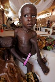 Amisso Ado, age 3 and weighing 12.8 pounds, is treated in a makeshift feed center in the town of Maradi, Niger, in this July 24 file photo. Conservationist J. Michael Fay, in an article published in September's National Geographic, says that misguided development efforts in Africa have contributed to the continent's chronic poverty and suffering.