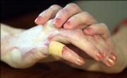 Leigh McHatton still has visible scars on her hands and feet from burns she suffered in the Boardwalk Apartments fire in October. McHatton will graduate from Kansas University on Sunday.