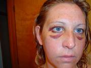 This photo, taken by a family member of Tara Balch's in early April, shows how she looked about five hours after an incident in which she said her boyfriend punched and choked her. Balch is now upset at how prosecutors in Jefferson County have handled her case.
