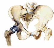 The Birmingham Hip Resurfacing System, shown here, is a metal cap fitted over the femoral bone, which fits into a metal socket inserted into the pelvis. The cap is shown in detail inset at left. Floyd Landis underwent this procedure last week.