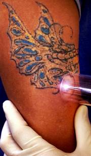A laser is used to remove a tattoo. A new company is introducing removable ink to make the process cheaper and easier.