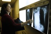 Dr.Lida Osbern, a pulmonologist with Reed Medical Group, 404 Maine, inspects a chest X-ray showing lung cancer. About 87 percent of lung cancer cases are caused by smoking. The Great American Smokeout, set for Thursday, encourages smokers to kick the habit.