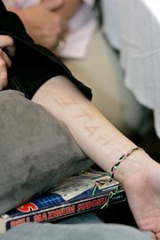 a former resident of Columbia Training School in Jackson, Miss., shows the "HATE ME" scar she allegedly gave herself using a toenail and sharpened toothpaste tube cap to cut into her arm while in solitary confinement. The state decided Feb. 14 to close the facility. However, several former students are suing the state for "horrendous physical and sexual abuse" at the school.