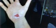 Former KU football player Cory Kipp damaged his hand after doing "bear crawls" as punishment after a practice in 2003.