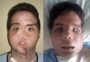 Oscar, a man who underwent a full-face transplant in April appears before, left, and after, right, the surgery at the Vall d’Hebron Hospital in Barcelona, Spain, in these undated photos released by the hospital.