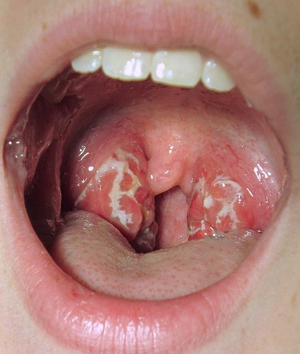 Home Strep Throat Test Cvs