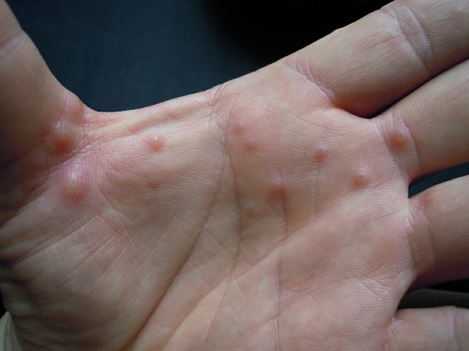 rash on hands and feet in adults #11