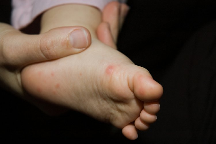 Hand, Foot, and Mouth Disease Symptoms & HFMD Pictures