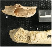 This figure shows the Neanderthal rib bone (marked "a") found to have contained a fibrous dysplasia tumor by David Frayer, a professor of anthropology at Kansas University, and other researchers. This image is published here under a Creative Commons Attribution License, and it originally appeared with the article "Fibrous Dysplasia in a 120,000+ Year Old Neandertal from Krapina, Croatia," by Janet Monge, Morrie Kricun, Jakov Radovčić, Davorka Radovčić, Alan Mann and David W. Frayer, published in PLOS ONE on June 5.